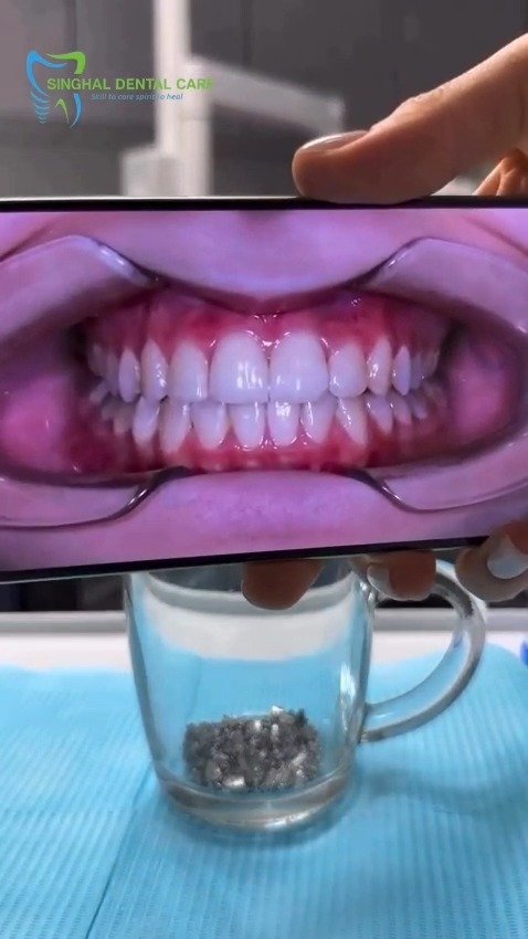 🦷 Don't let crooked or crowded teeth affect your confidence!

At Singhal Dental Care, we offer professional braces treatment to help align your teeth, improve your bite, and give you the beautiful smile you deserve.

✅ Correct crooked & crowded teeth
✅ Improve smile aesthetics
✅ Better oral hygiene & easier cleaning
✅ Enhanced confidence & self-esteem
✅ Personalized orthodontic treatment

📍 C-26, Sector-C, Alkapuri Tiraha, Aliganj, Lucknow
📞 829901516

Braces Treatment Lucknow
Orthodontist in Lucknow
Teeth Alignment Treatment
Metal Braces Cost Lucknow
Dental Braces Clinic Aliganj
Best Dentist for Braces
Crooked Teeth Treatment
Teeth Straightening
Smile Makeover Lucknow
Singhal Dental Care
Orthodontic Treatment
Braces for Teenagers
Adult Braces Treatment
Dental Clinic Aliganj Lucknow
Perfect Smile Treatment

#BracesTreatment #BracesLucknow #Orthodontics #TeethStraightening #SmileTransformation #PerfectSmile #DentalCare #Orthodontist #CrookedTeeth #SmileMakeover #LucknowDentist #DentalClinic #AliganjLucknow #SinghalDentalCare #HealthySmile #MetalBraces #DentalHealth #ConfidenceStartsWithASmile #TeethAlignment #SmileGoals