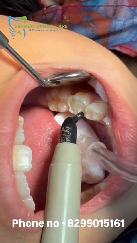 🦷 Tooth-Colored Dental Filling Treatment
🦷 Restore your smile with advanced tooth-colored dental fillings at Singhal Dental Care. This treatment helps repair teeth affected by cavities and decay while maintaining a natural appearance. Composite fillings blend seamlessly with your teeth, providing strength, durability, and excellent aesthetics.
📞 Appointment: 082990 15161
Dental Filling, Tooth Colored Filling, Composite Filling, Cavity Treatment, Dental Caries Treatment, Tooth Restoration, Painless Dental Treatment, Cosmetic Dentistry, Dental Clinic Lucknow, Dentist Near Me, Cavity Filling, Smile Restoration, Dental Care, Tooth Decay Treatment, Singhal Dental Care
#DentalFilling #CompositeFilling #ToothRestoration #CavityTreatment #DentalCare #HealthySmile #CosmeticDentistry #ToothDecay #Dentist #OralHealth #SmileMakeover #DentalClinic #LucknowDentist #SinghalDentalCare #HealthyTeethHappyKids