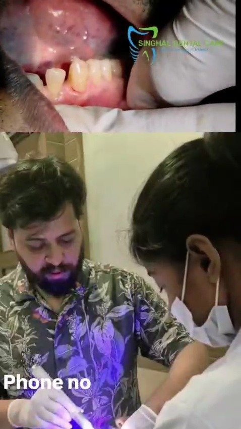🦷 Cervical Abrasion: Early Signs, Causes & Treatment Options

🦷 Cervical Abrasion is a common dental condition where the tooth structure near the gum line gradually wears away due to aggressive brushing, hard-bristled toothbrushes, or improper oral habits. This can lead to tooth sensitivity, pain while consuming hot or cold foods, and increased risk of further tooth damage. Early diagnosis and treatment can help preserve your natural teeth and improve oral health. Visit your dentist for professional evaluation and personalized treatment options.

cervical abrasion, tooth abrasion, cervical abrasion treatment, tooth wear near gums, toothbrush abrasion, gum line erosion, sensitive teeth treatment, dental abrasion, tooth sensitivity, enamel loss, cervical lesion, non carious cervical lesion, dental clinic near me, dentist near me, tooth wear treatment, dental care near me

#DentistNearMe
#DentalClinicNearMe
#DentalCareNearMe
#BestDentistNearMe
#EmergencyDentistNearMe
#TeethCleaningNearMe
#RootCanalNearMe
#DentalImplantNearMe
#SmileMakeoverNearMe
#OrthodontistNearMe
#FamilyDentistNearMe
#AffordableDentistNearMe
#DentalTreatmentNearMe
#OralCareNearMe
#NearbyDentist
#LucknowDentist
#LucknowDentalClinic
#DentalCareLucknow
#VishalDentalCare
#healthysmile