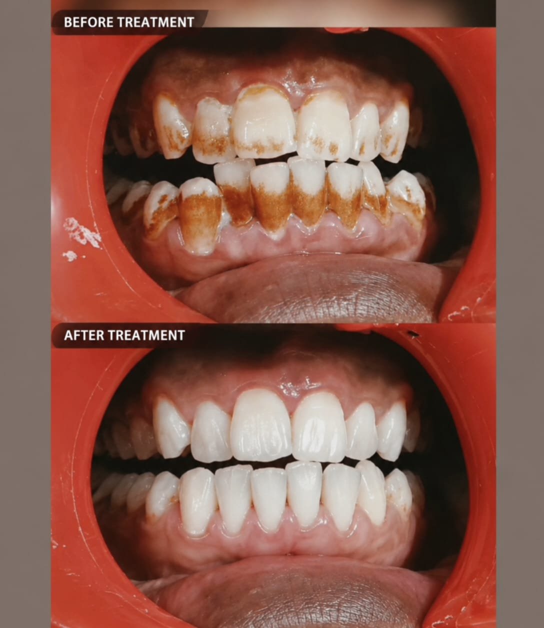 Best Teeth Cleaning & Scaling in Lucknow | Plaque & Tartar Removal

Benefits of Professional Teeth Cleaning

✅ Removes Hard Tartar & Plaque

✅ Reduces Bad Breath

✅ Improves Gum Health

✅ Removes Surface Stains

✅ Helps Prevent Gum Disease

✅ Gives a Cleaner, Healthier Smile

📍 Singhal Dental Care, Aliganj, Lucknow

📞 Call / WhatsApp: 8299015161

Teeth Cleaning Lucknow
Dental Scaling Lucknow
Scaling and Polishing
Professional Teeth Cleaning
Tartar Removal
Plaque Removal
Teeth Cleaning Near Me
Gum Cleaning
Dental Cleaning Clinic
Scaling Treatment

Teeth Cleaning Aliganj
Scaling Lucknow
Dentist Aliganj
Dental Clinic Lucknow
Teeth Cleaning Near Me
Scaling Near Me
Gum Treatment Lucknow
Singhal Dental Care Lucknow

#TeethCleaning #Scaling #DentalScaling #ProfessionalCleaning #PlaqueRemoval #TartarRemoval #HealthyGums#LucknowDentist #AliganjLucknow #DentalClinicLucknow #TeethCleaningLucknow #ScalingLucknow#SinghalDentalCare #HealthySmile #OralHealth #PreventiveDentistry #SmileCare