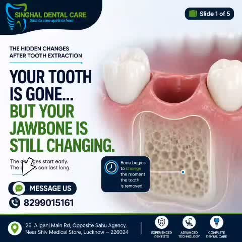 Missing Teeth? Restore Your Smile with Dental Implants | Lucknow

🦷 A missing tooth doesn't just leave a gap—it can affect your smile, chewing, and confidence.

Benefits of Dental Implants

✅ Natural-looking appearance

✅ Comfortable chewing

✅ Stable and fixed solution

✅ Helps restore confidence

✅ Supports long-term oral function

📍 Singhal Dental Care
26, Aliganj Main Road, Opposite Sahu Agency, Near Shiv Medical Store, Lucknow – 226024

📞 Call / WhatsApp: 8299015161

Dental Implants Lucknow
Missing Teeth Treatment
Tooth Replacement Lucknow
Dental Implant Clinic Lucknow
Single Tooth Implant
Permanent Tooth Replacement
Implant Dentist Lucknow
Missing Tooth Solution
Smile Restoration
Dental Implant Consultation

Dental Implants Aliganj
Implant Dentist Aliganj
Best Dentist Lucknow
Missing Tooth Treatment Lucknow
Tooth Replacement Aliganj
Dental Clinic Aliganj
Dental Implant Consultation Lucknow
Singhal Dental Care Lucknow

#DentalImplants #MissingTeeth #ToothReplacement #SmileRestoration #ImplantDentistry #PermanentSmile #HealthySmile#DentalImplantsLucknow #LucknowDentist #AliganjLucknow #DentalClinicLucknow #ImplantDentistLucknow#SinghalDentalCare #SmileConfidence #DentalCare #HealthyTeeth #ImplantJourney #SmileAgain