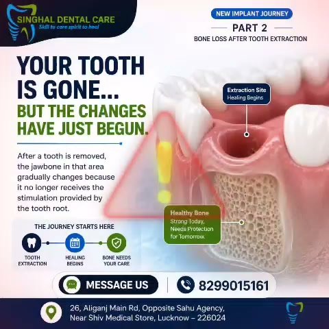 Bone Loss After Tooth Extraction | Dental Implant Awareness | Lucknow

🦷 Your tooth is gone... but the changes have only begun.

What happens beneath the gums after a tooth is removed may surprise you.

Dental implants may help by:

✔ Replacing the missing tooth root

✔ Restoring chewing ability

✔ Supporting a natural-looking smile

✔ Helping maintain long-term oral function

📍 Singhal Dental Care

26, Aliganj Main Road,

Opposite Sahu Agency,

Near Shiv Medical Store,

Lucknow – 226024

📞 Call / WhatsApp: 8299015161

Bone Loss After Tooth Extraction
Dental Implant Lucknow
Missing Tooth Treatment
Tooth Extraction Recovery
Tooth Replacement Lucknow
Jawbone Loss
Dental Implant Clinic
Implant Dentist Lucknow
Missing Teeth Solution
Bone Preservation Dentistry

Dental Implant Aliganj
Implant Dentist Lucknow
Tooth Replacement Lucknow
Missing Teeth Treatment Lucknow
Dental Clinic Aliganj
Best Dentist Aliganj
Implant Consultation Lucknow
Singhal Dental Care Lucknow

#DentalImplants #MissingTeeth #ToothReplacement #BoneLoss #ToothExtraction #JawboneHealth #SmileRestoration#DentalImplantsLucknow #LucknowDentist #AliganjLucknow #DentalClinicLucknow #ImplantDentistLucknow#SinghalDentalCare #HealthySmile #TrustedDentalCare #DentalAwareness #SmileWithConfidence #ImplantJourney