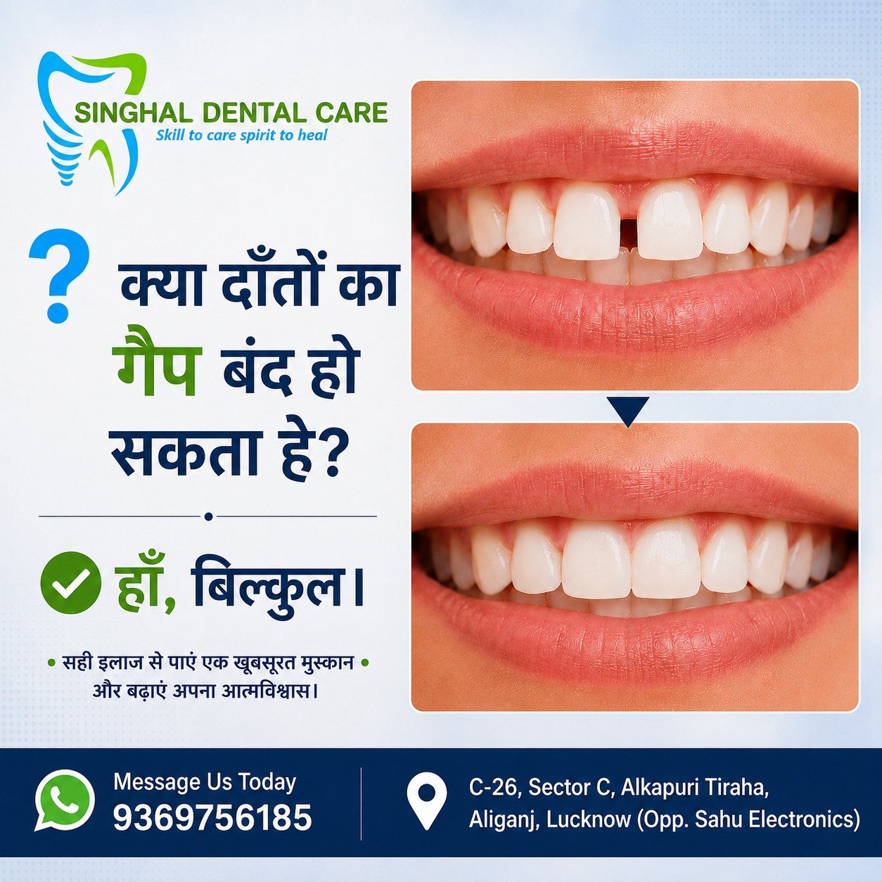 क्या दाँतों का Gap बंद हो सकता है? हाँ—सही Treatment से

Front teeth के बीच gap या spacing smile confidence को प्रभावित कर सकती है। Gap size, bite और tooth position के अनुसार braces, clear aligners या cosmetic gap closure जैसे treatment options चुने जा सकते हैं। Singhal Dental Care, Aliganj, Lucknow में smile consultation book करें।

क्या front teeth का gap आपकी smile और confidence को प्रभावित कर रहा है?

हर spacing case अलग होता है। Treatment gap के size, bite और teeth position देखकर plan किया जाता है।

✅ Braces से gap closure
✅ Clear aligners का option
✅ Selected cases में cosmetic treatment
✅ Natural-looking smile planning
✅ Confidence बेहतर हो सकता है

📍 Singhal Dental Care, Aliganj, Lucknow
📞 9369756185

teeth gap treatment Lucknow, front teeth gap closure, dental spacing treatment, diastema treatment Lucknow, braces for teeth gap, clear aligners Aliganj, cosmetic gap closure, smile correction Lucknow, orthodontic treatment Aliganj, front teeth spacing dentist, dental clinic near Sahu Electronics, Singhal Dental Care

#TeethGap #GapClosure #FrontTeethSpacing #DiastemaTreatment #BracesTreatment #ClearAligners #SmileCorrection #ConfidentSmile #AliganjLucknow #LucknowDentist #SinghalDentalCare
