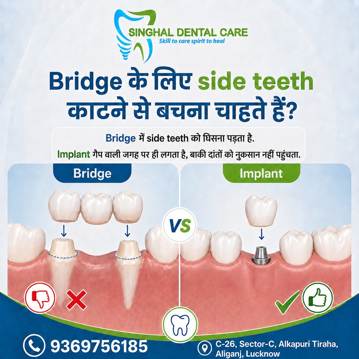 Missing Tooth के लिए Implant एक Tooth-Saving Option हो सकता है

Missing tooth के लिए bridge में पास के healthy teeth को support के लिए घिसना पड़ सकता है। Dental implant gap वाली जगह पर लगाया जाता है और बाकी दांतों को unnecessary damage से बचाने में मदद कर सकता है। सही option tooth condition, bone support और bite के अनुसार decide होता है.

📍 Singhal Dental Care, Aliganj, Lucknow
📞 Call/WhatsApp: 8299015161

missing tooth replacement, dental bridge vs implant, side teeth grinding in bridge, implant without cutting side teeth, single tooth implant, gap tooth replacement, bridge alternative, dental implant option, tooth replacement treatment, preserve natural teeth, fixed tooth replacement, implant for missing tooth, dental implant planning

#DentalBridge
#DentalImplant
#BridgeVsImplant
#MissingTooth
#ToothReplacement
#SingleToothImplant
#PreserveNaturalTeeth
#HealthyTeeth
#FixedTooth
#ImplantTreatment
#DentalAwareness
#OralHealth
#smilerestoration 
#LucknowPeople
#lucknowcity 
#Kapoorthala
#mahanagarlucknow 
#IndiraNagarLucknow
#GomtiNagarLucknow
#JankipuramLucknow