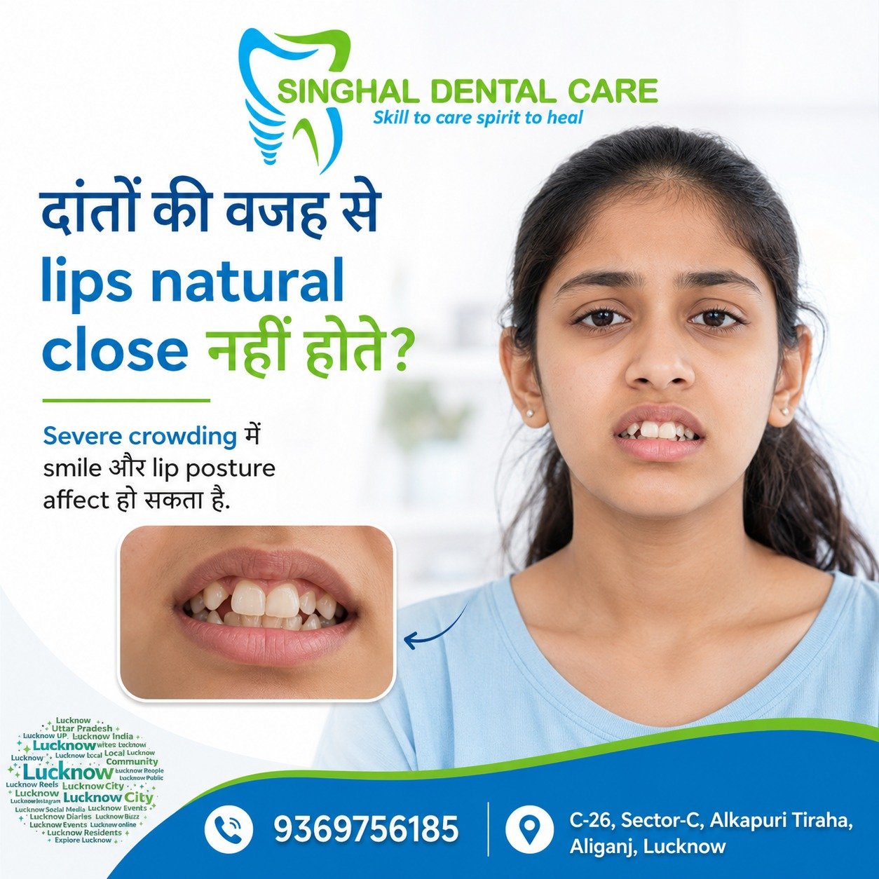 दांतों की Crowding से Lips Proper Close नहीं हो रहे?

Severe crowding सिर्फ smile को affect नहीं करती, बल्कि lips naturally close होने, speaking comfort और overall facial appearance पर भी असर डाल सकती है। सही orthodontic check-up से teeth alignment, crowding level और braces treatment plan समझा जा सकता है.

📍 Singhal Dental Care
Dr. Mohit Singhal
C-26, Sector-C, Alkapuri Tiraha, Aliganj, Lucknow
📞 9369756185

severe teeth crowding, crowded teeth treatment, lips not closing naturally, lip posture problem, teeth alignment issue, braces for crowded teeth, orthodontic treatment, misaligned teeth, crooked teeth correction, smile correction, teeth crowding in children, braces consultation, facial smile balance, dental crowding treatment, teeth straighteningAlambagh, Nishatganj, Nirala Nagar, Sitapur Road, Kursi Road, Faizabad Road, Kanpur Road, Polytechnic Chauraha, IT Chauraha, Purania Chauraha, Engineering College Chauraha, Munshipulia, Bhootnath Market, Patrakarpuram

#TeethCrowding, #CrowdedTeeth, #SevereCrowding, #LipPosture, #LipsNotClosing, #TeethAlignment, #CrookedTeeth, #MisalignedTeeth, #BracesTreatment, #OrthodonticTreatment, #SmileCorrection, #TeethStraightening, #DentalAwareness, #OralHealth, #DentalCare#Lucknow, #LucknowPeople, #LucknowWale, #Lucknowites, #LucknowCity, #LucknowLocal, #LucknowLife, #LucknowDiaries, #PeopleOfLucknow, #AliganjLucknow, #Kapoorthala, #MahanagarLucknow, #GomtiNagar, #IndiraNagarLucknow, #Jankipuram