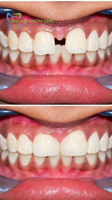 Before to After Smile Transformation

See the visible difference in this before-and-after smile correction case. Front teeth shape, gap, and smile appearance can often be improved for a more natural and confident look. Visit Singhal Dental Care, Aliganj, Lucknow for expert dental consultation.

front teeth gap treatment Lucknow, smile correction Lucknow, cosmetic dental treatment Lucknow, teeth gap closure Lucknow, front tooth correction Lucknow, smile makeover Lucknow, uneven teeth treatment Lucknow, composite smile correction Lucknow, aesthetic dental treatment Lucknow, dental clinic in Aliganj Lucknow, best dentist for smile correction Lucknow, natural smile restoration Lucknow, before after dental treatment Lucknow, front teeth reshaping Lucknow, dental smile improvement Lucknow

#SmileCorrection, #BeforeAfterSmile, #TeethGapClosure, #FrontTeethCorrection, #SmileMakeover, #CosmeticDentistry, #DentalTreatment, #NaturalSmile, #AestheticDentistry, #LucknowDentist, #DentalClinicLucknow, #AliganjLucknow, #SinghalDentalCare, #SmileTransformation, #ConfidentSmile