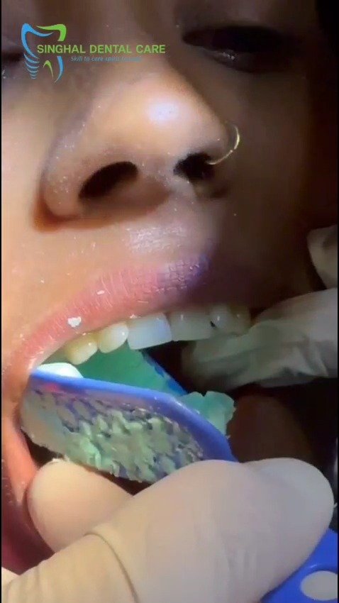 Accurate Dental Treatment के लिए Teeth Impression जरूरी है

Dental treatment शुरू करने से पहले teeth impression या mould लेकर दांतों की exact shape और bite record की जाती है। इससे crown, bridge, denture, braces या aligners की fitting ज्यादा accurate और comfortable बनाने में मदद मिलती है.

dental impression, teeth mould, dental moulding process, teeth measurement, bite recording, dental treatment planning, custom dental appliance, crown impression, bridge impression, denture impression, braces impression, aligner impression, accurate dental fitting, custom fit dental treatment, dental procedure.

#DentalImpression, #TeethMould, #DentalMoulding, #BiteRecording, #DentalTreatmentPlanning, #CustomFit, #DentalProcedure, #CrownImpression, #BridgeImpression, #DentureImpression, #BracesTreatment, #AlignersTreatment, #DentalCare, #OralHealth, #DentalClinic
