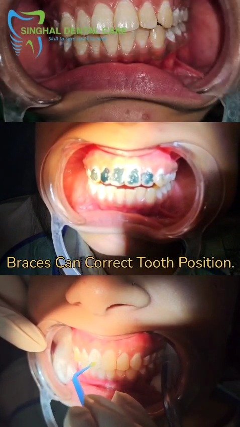 Braces Can Correct Tooth Position

Crooked teeth, gaps या misaligned teeth में braces treatment से दांतों की position gradually improve की जा सकती है। Proper orthodontic planning से smile alignment, bite balance और overall dental appearance बेहतर हो सकती है.

braces treatment, tooth position correction, teeth alignment, crooked teeth treatment, misaligned teeth, crowded teeth treatment, gap correction braces, orthodontic treatment, braces adjustment, braces procedure, smile alignment, bite correction, teeth straightening, dental braces, smile correction

## Descriptor

Video का focus **braces treatment process और tooth position correction** पर है। Braces धीरे-धीरे teeth alignment, crowding, spacing और bite position को improve करने में help कर सकते हैं.

## Meta Ads Headline

**Braces Can Correct Tooth Position**

## Meta Ads Description

Crooked teeth, gaps या misaligned teeth में braces treatment से दांतों की position gradually improve की जा सकती है। Proper orthodontic planning से smile alignment, bite balance और overall dental appearance बेहतर हो सकती है.

## Keywords

braces treatment, tooth position correction, teeth alignment, crooked teeth treatment, misaligned teeth, crowded teeth treatment, gap correction braces, orthodontic treatment, braces adjustment, braces procedure, smile alignment, bite correction, teeth straightening, dental braces, smile correction

## Hashtags

#BracesTreatment, #DentalBraces, #ToothPosition, #TeethAlignment, #CrookedTeeth, #MisalignedTeeth, #CrowdedTeeth, #GapCorrection, #OrthodonticTreatment, #BracesAdjustment, #TeethStraightening, #SmileCorrection, #BiteCorrection, #DentalCare, #OralHealth