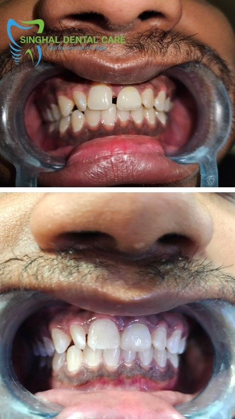 Real Patient Teeth Cleaning Transformation

Tobacco stains, tartar, plaque और yellow deposits normal brushing से पूरी तरह साफ नहीं होते। Professional teeth cleaning / scaling से दांतों की सफाई, gum health, fresh breath और smile appearance improve करने में मदद मिल सकती है.

teeth cleaning, dental scaling, real patient dental cleaning, before after teeth cleaning, tartar removal, plaque removal, tobacco stain removal, yellow teeth cleaning, teeth polishing, stained teeth cleaning, gum cleaning, fresh breath, professional dental cleaning, clean smile, dental cleaning Lucknow, scaling treatment Aliganj

#TeethCleaning, #DentalScaling, #BeforeAfterCleaning, #TartarRemoval, #PlaqueRemoval, #TobaccoStains, #YellowTeeth, #TeethPolishing, #CleanSmile, #FreshBreath, #GumCleaning, #RealPatientResult, #DentalCare, #OralHealth, #LucknowDental, #AliganjLucknow